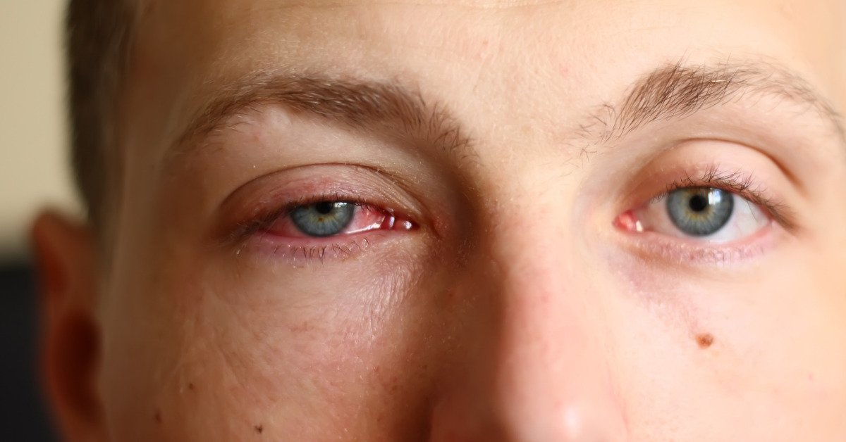 Pakistan identifies coxsackievirus A24 as cause of recent pink eye outbreak. Read.pk