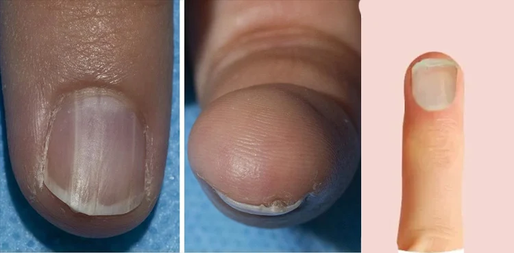The Silent Indicators: How Nails Reflect Our Health