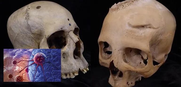 Ancient Egyptian Attempts to Treat Cancer Discovered Through 4,000-Year-Old Skulls
