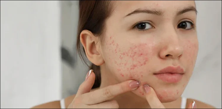 Expert Tips for Preventing Heat-Related Skin Issues in Summer