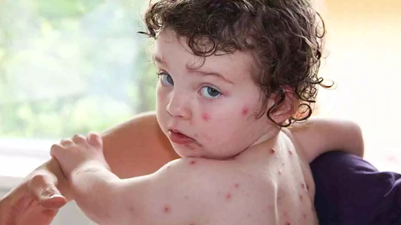 TC-Section Babies Require Two Doses of Measles Vaccine for Adequate Immunity, Study Finds